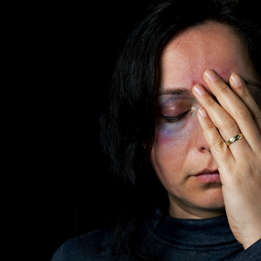 Victim with bruised eye after experiencing domestic and family violence